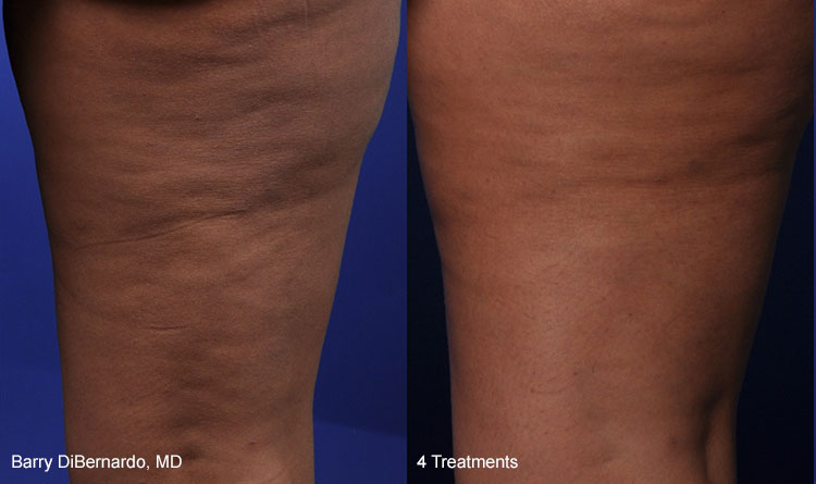 THERMIsmooth® is a non-invasive dermal remodeling treatment used to tighten the skin and reduce the appearance of cellulite in a variety of body areas.