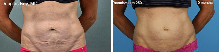 THERMIsmooth® is a non-invasive dermal remodeling treatment used to tighten the skin and reduce the appearance of cellulite in a variety of body areas.