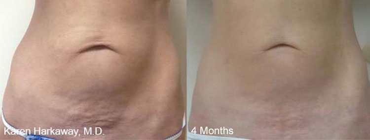 THERMIsmooth® is a non-invasive dermal remodeling treatment used to tighten the skin and reduce the appearance of cellulite in a variety of body areas.